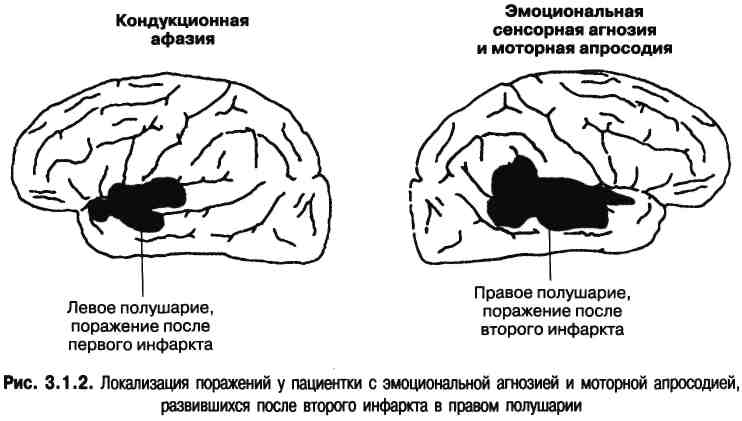 Поражение левого полушария мозга. Агнозия и афазия. Локализации поражения головного мозга при афазии. Локализация поражений мозга при афазии. Мозг при афазии.